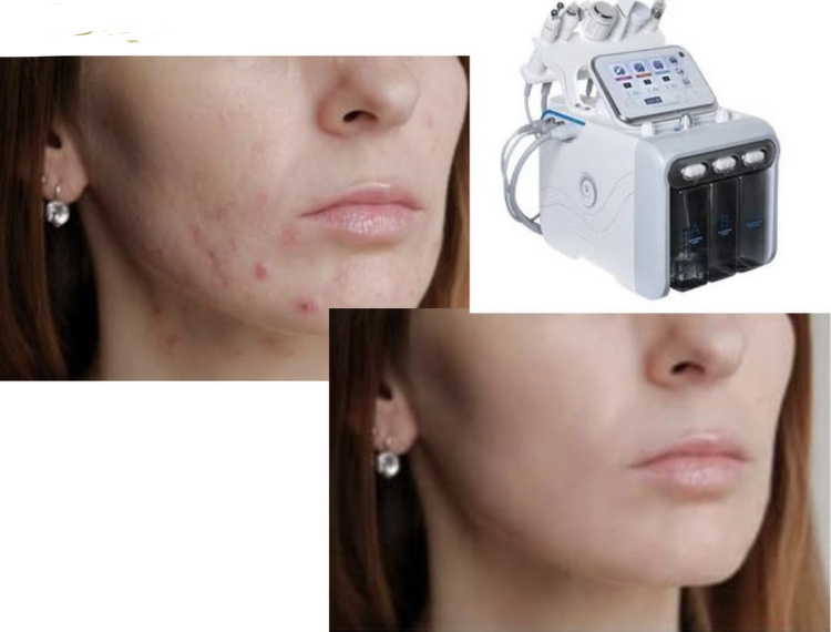 HydraFacial kezelés